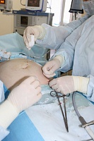 Мозг нерожденного младенца прооперировали в утробе матери