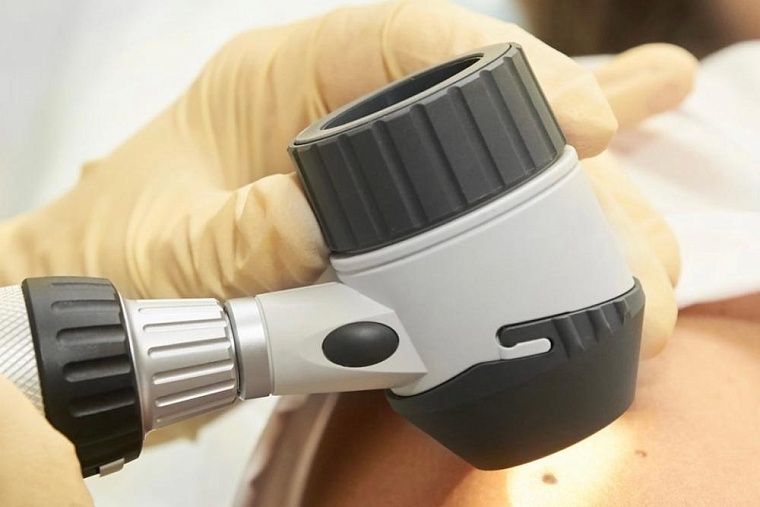 За один день в тюменском Медгороде выявили 13 случаев рака кожи