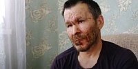 Лесничего, пострадавшего в пожаре в Вагайском районе, хотят наградить за отвагу