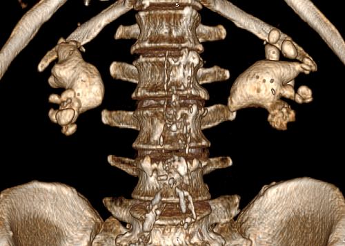 От коралловидных камней в почках тюменца избавили в два этапа
