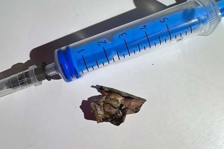 Инородный предмет в носу: тобольские врачи спасли ребенка