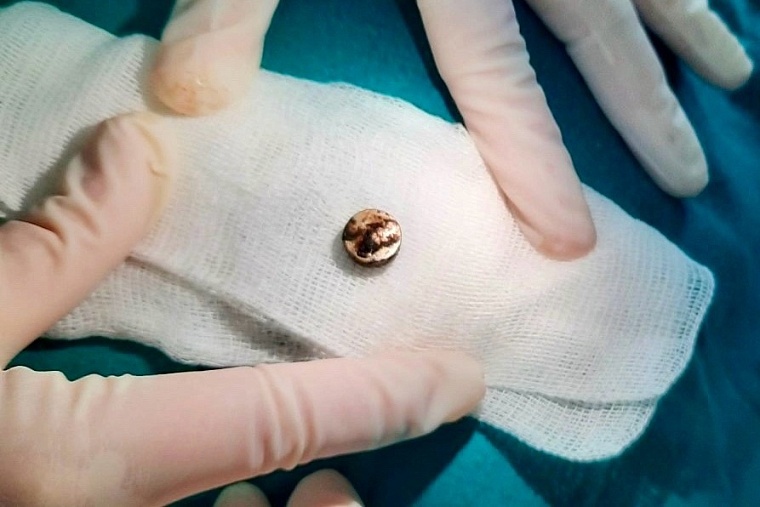 Батарейка в носу стала причиной отека лица и высокой температуры у малыша в Тобольске