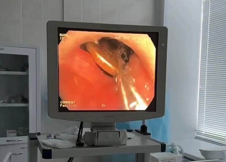 Тюменские врачи достали из пищевода ребенка десятирублевую монету