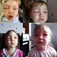 Летняя аллергия: виды, симптомы и лечение