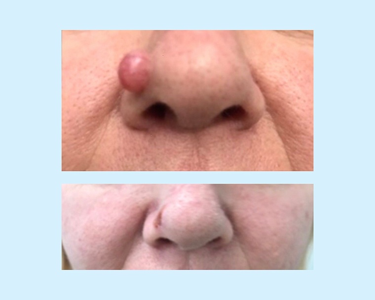 Женщине в Тюмени удалили родинку, которая оказалась злокачественным образованием