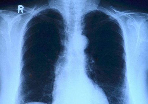 В Тюменской области составили рейтинг районов, наиболее благополучных по туберкулезу