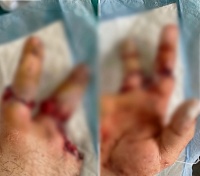 Тюменец отрезал себе пальцы циркулярной пилой