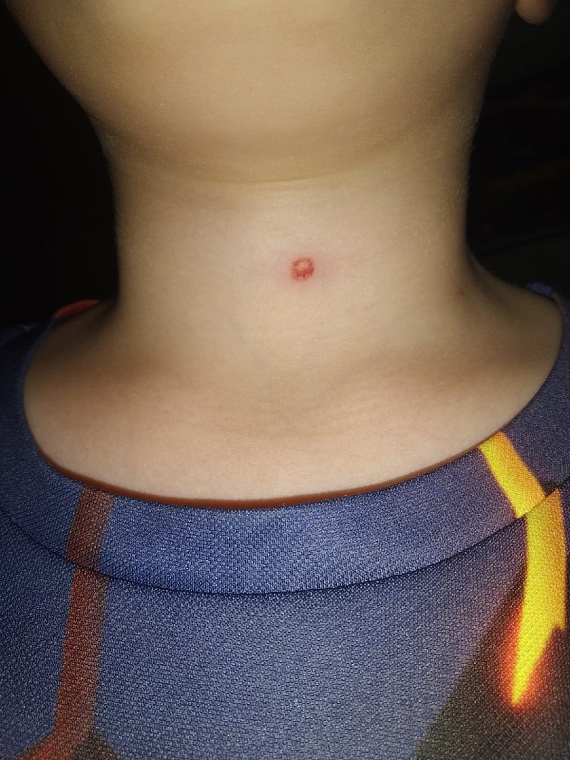 Прокурор Тюменской области взял на контроль факт травмирования детей в поселке Московском