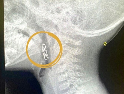 В Ишиме врачи спасли шестилетнего мальчика с застрявшей пружинкой в горле