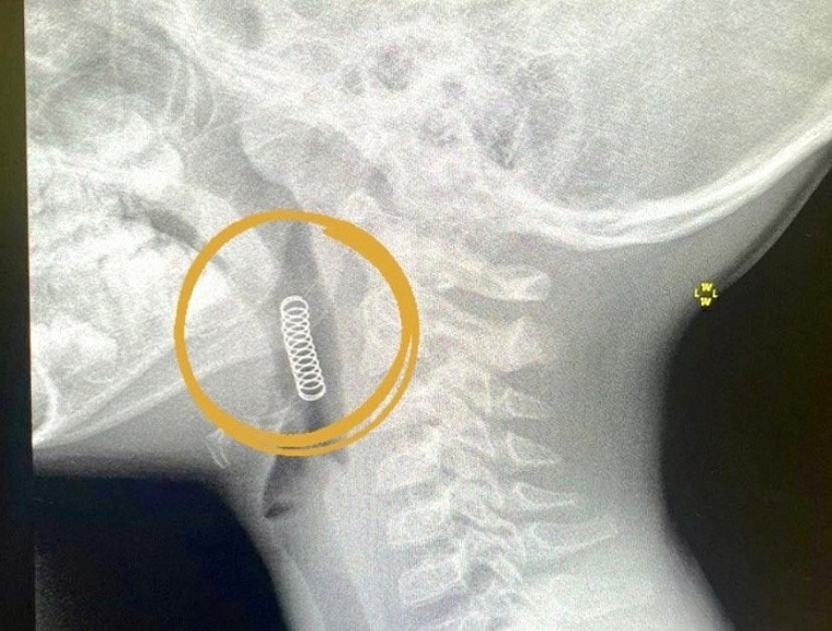 В Ишиме врачи спасли шестилетнего мальчика с застрявшей пружинкой в горле