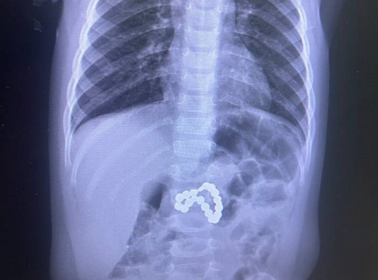 Сургутские врачи спасли проглотившую магниты девочку