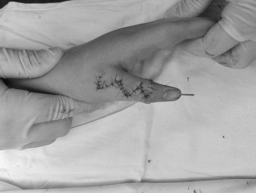 В Тюмени врачи удалили девочке шестой палец на руке