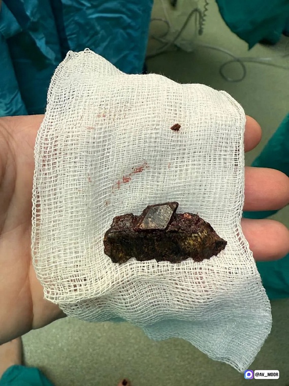 Александр Моор рассказал об уникальной операции по извлечению «бомбы замедленного действия» из тела бойца СВО