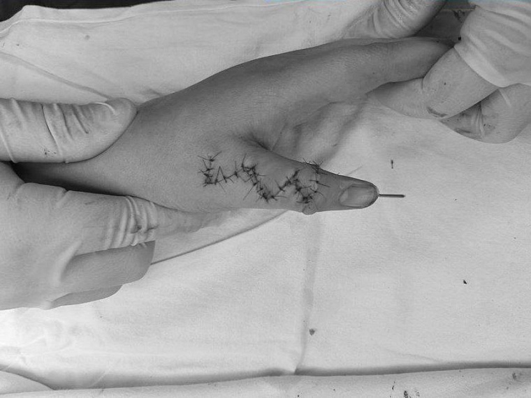 В Тюмени врачи удалили девочке шестой палец на руке