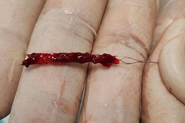 В Тюмени врачи спасли молодого пациента от тяжелых последствий инсульта