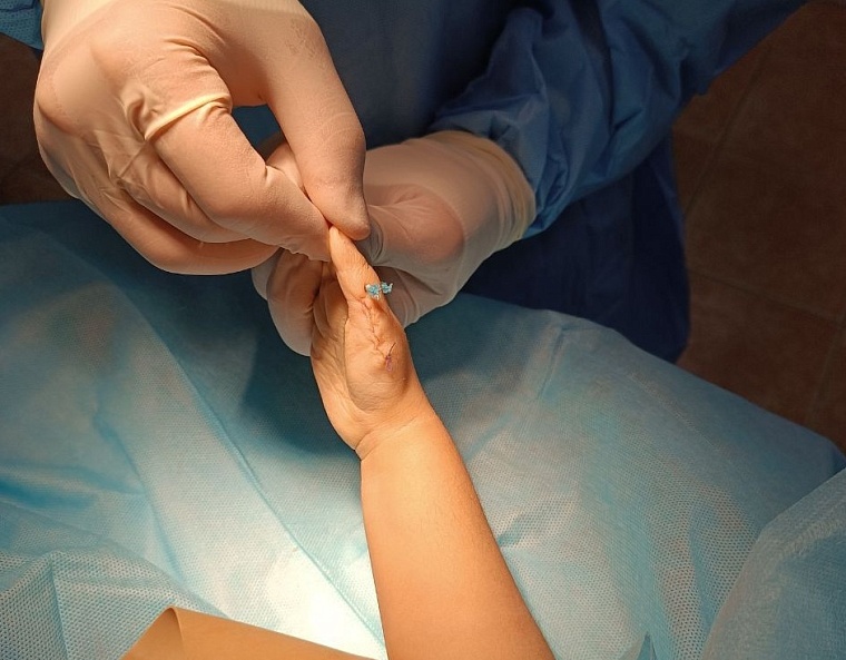 Тюменские врачи исправили дефект пальцев на руке двухлетней девочке