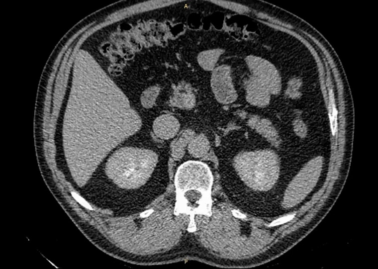 Впервые в Тюменской области проведена уникальная операция на почке